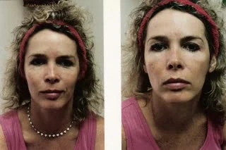 facial_ab_1_web