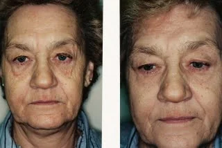 facial_ab_2_web